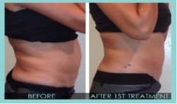 Premier Body Sculpt Before-After